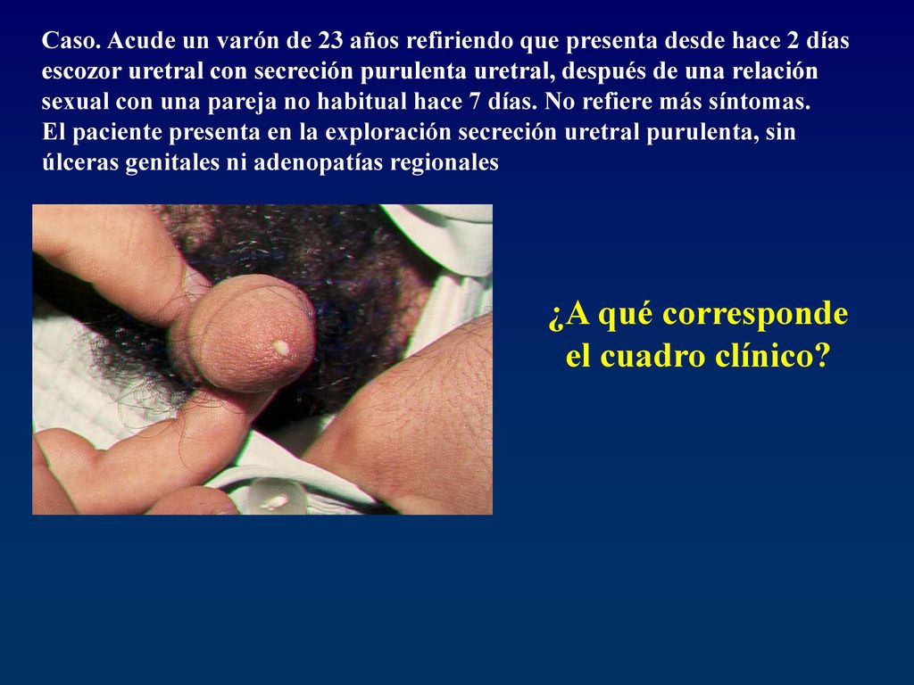 uretritis purulenta uretritis purulenta